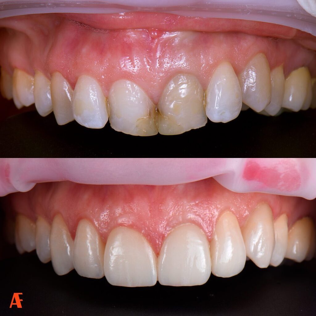 Faccette dentali pesaro