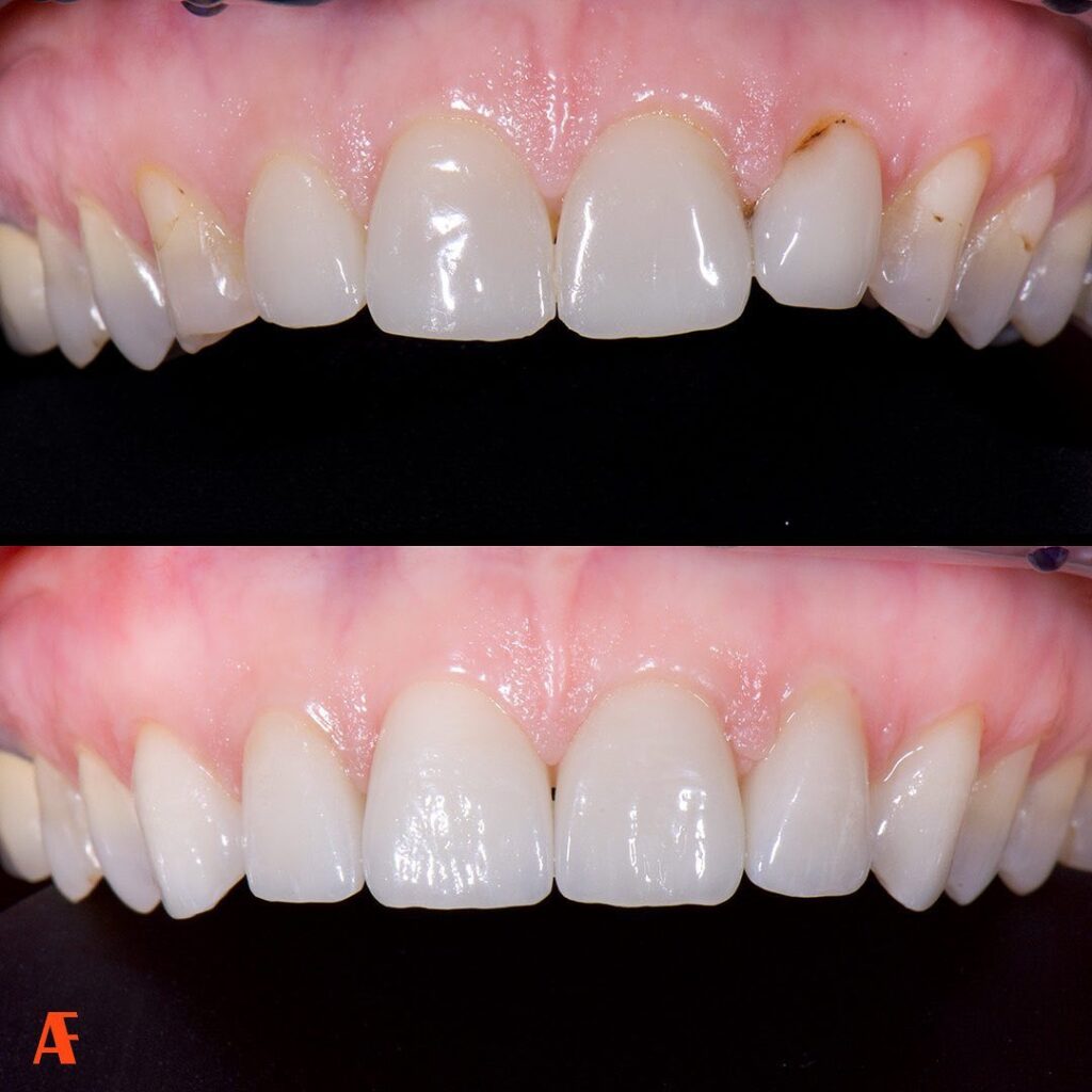 Riabilitazione estetica del gruppo frontale con faccette dentali pesaro