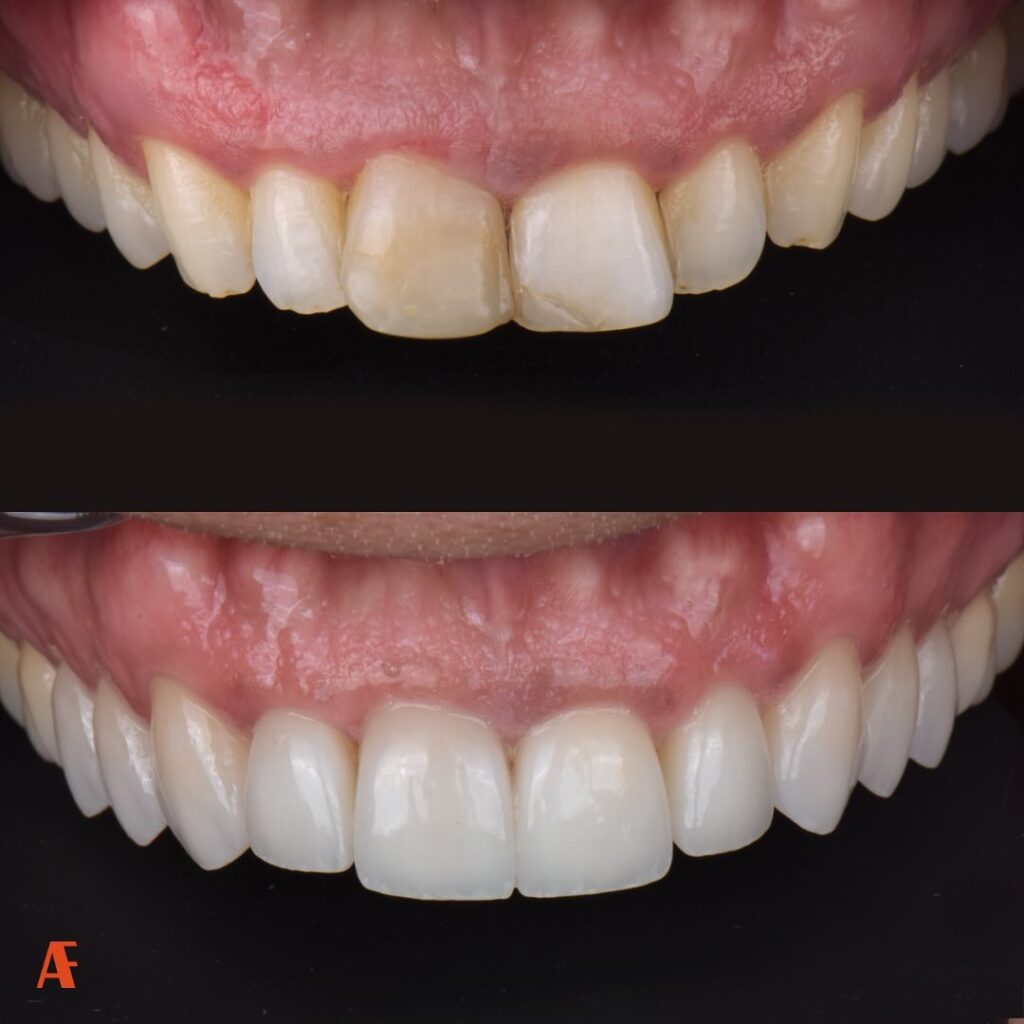 Riabilitazione estetica con faccette dentali pesaro